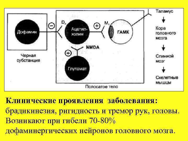 Клинические проявления заболевания: брадикинезия, ригидность и тремор рук, головы. Возникают при гибели 70 80%