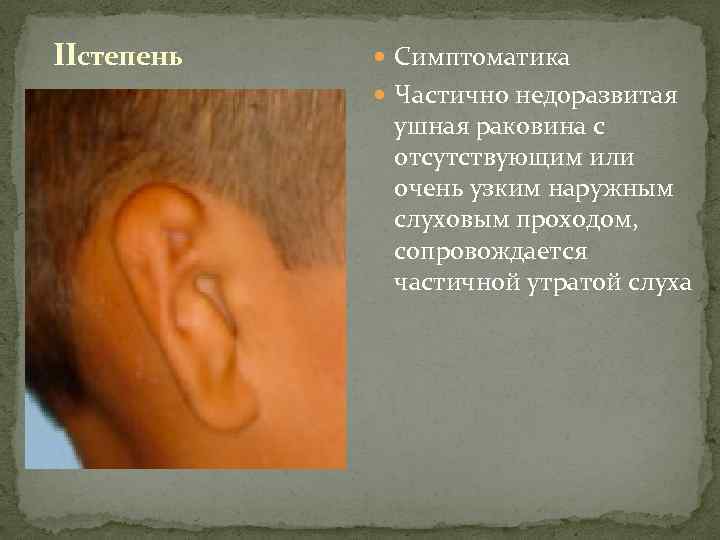 IIстепень Симптоматика Частично недоразвитая ушная раковина с отсутствующим или очень узким наружным слуховым проходом,