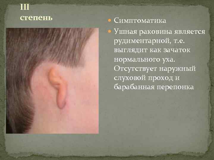 III степень Симптоматика Ушная раковина является рудиментарной, т. е. выглядит как зачаток нормального уха.