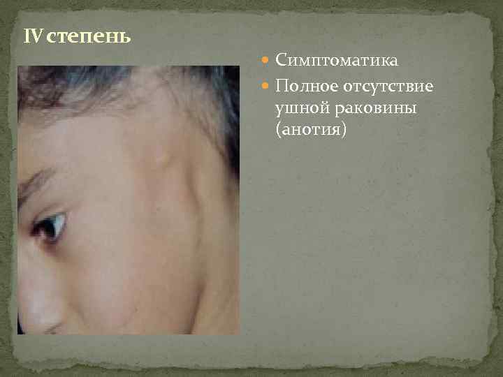 IV степень Симптоматика Полное отсутствие ушной раковины (анотия) 