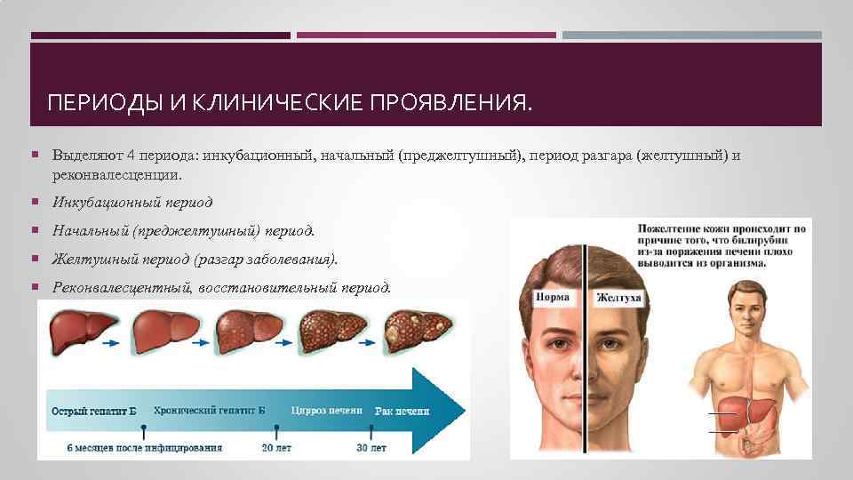 ПЕРИОДЫ И КЛИНИЧЕСКИЕ ПРОЯВЛЕНИЯ. Выделяют 4 периода: инкубационный, начальный (преджелтушный), период разгара (желтушный) и