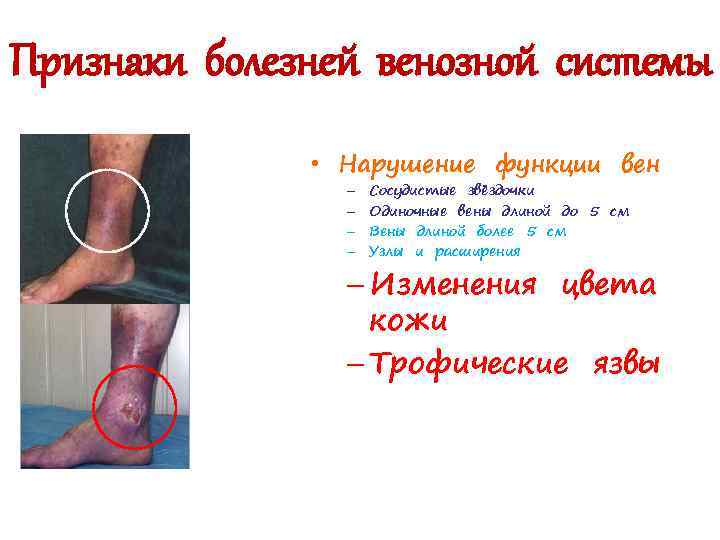 Признаки болезней венозной системы • Нарушение функции вен – – Сосудистые звёздочки Одиночные вены