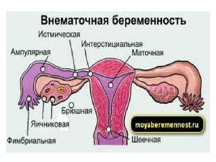 Эктопическая беременность. Внематочная беременность презентация. Клинические формы внематочной беременности. Внематочная беременность схема. Рентген внематочной беременности.