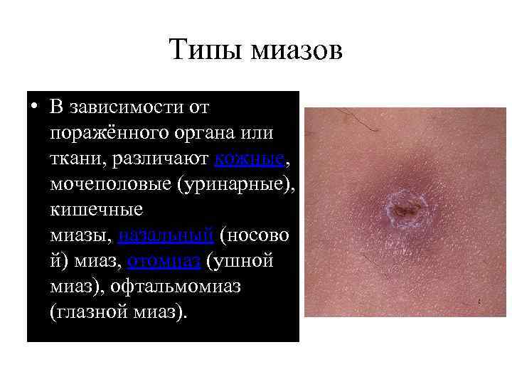 Типы миазов • В зависимости от поражённого органа или ткани, различают кожные, мочеполовые (уринарные),