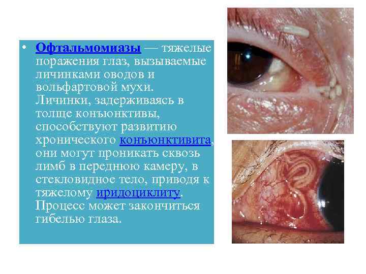  • Офтальмомиазы — тяжелые поражения глаз, вызываемые личинками оводов и вольфартовой мухи. Личинки,