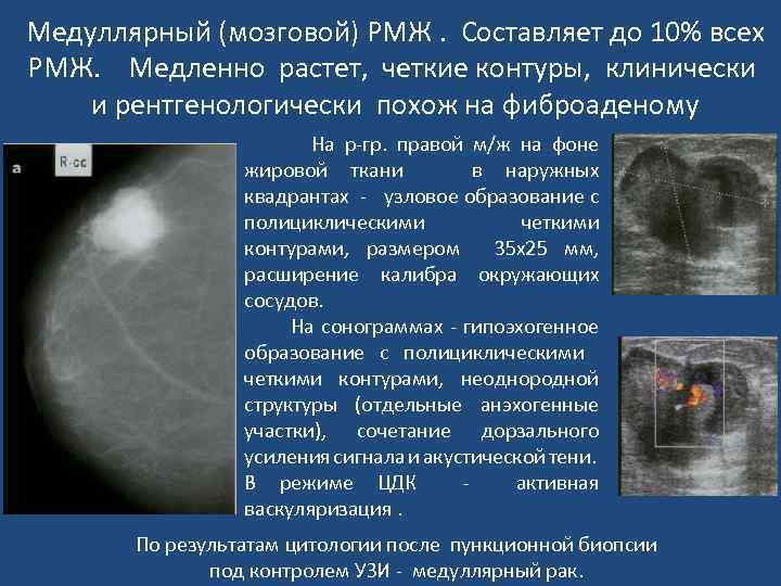 Рак молочной железы жизнь после. Маммография фиброаденома. Злокачественные заболевания молочных желез. Доброкачественное образование в молочной железе. Локализация опухоли в молочной железе.