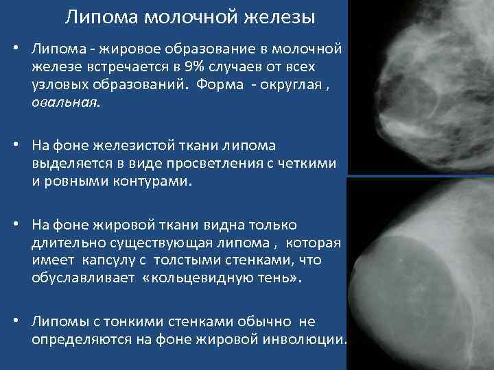 Фиброзные жировые изменения. Фибролипома маммография. Липома мышечной железы. Липома молочной железы на маммограмме.