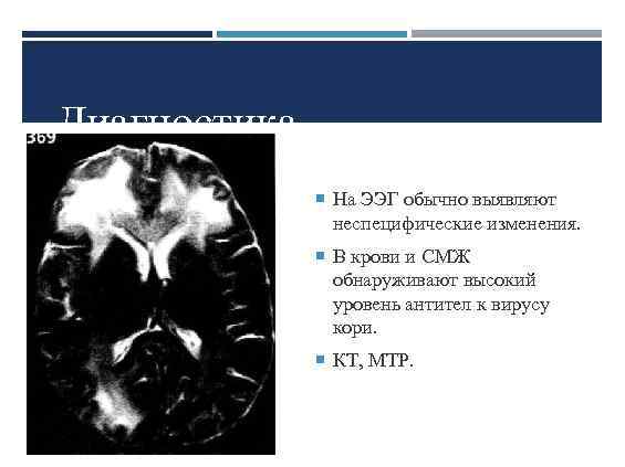 Диагностика На ЭЭГ обычно выявляют неспецифические изменения. В крови и СМЖ обнаруживают высокий уровень