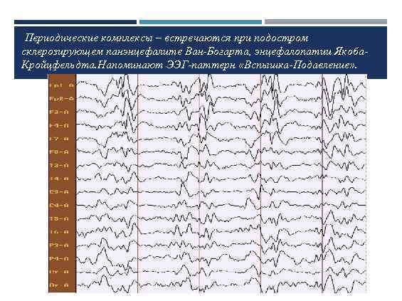  Периодические комплексы – встречаются при подостром склерозирующем панэнцефалите Ван-Богарта, энцефалопатии Якоба. Кройцфельдта. Напоминают