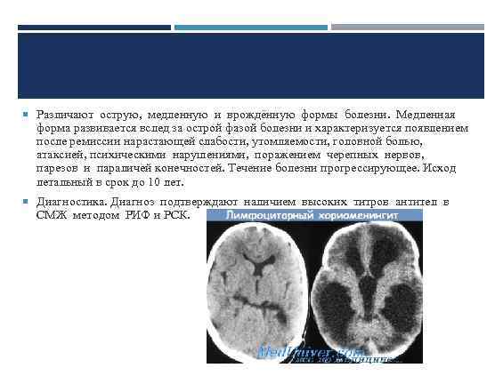  Различают острую, медленную и врождённую формы болезни. Медленная форма развивается вслед за острой