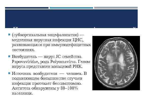 Прогрессирующая мультифокальная лейко (субкортикальная энцефалопатия) — медленная вирусная инфекция ЦНС, развивающаяся при иммунодефицитных состояниях.