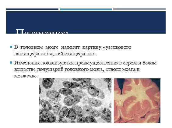 Патогенез В головном мозге находят картину «узелкового панэнцефалита» , лейкоэнцефалита. Изменения локализуются преимущественно в