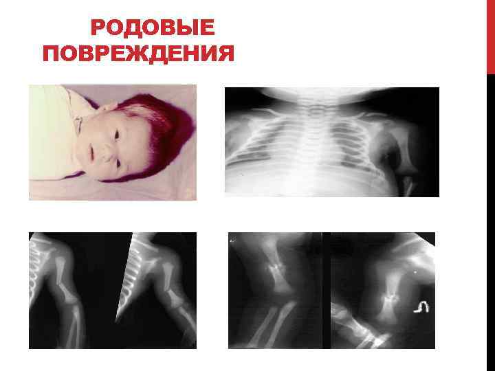 РОДОВЫЕ ПОВРЕЖДЕНИЯ 