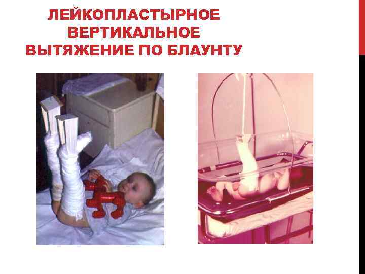 ЛЕЙКОПЛАСТЫРНОЕ ВЕРТИКАЛЬНОЕ ВЫТЯЖЕНИЕ ПО БЛАУНТУ 