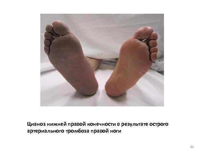 Цианоз нижней правой конечности в результате острого артериального тромбоза правой ноги 31 