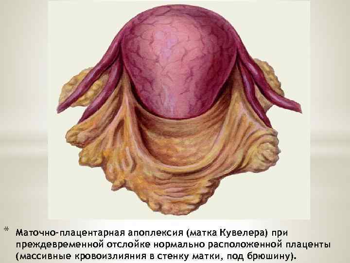 * Маточно-плацентарная апоплексия (матка Кувелера) при преждевременной отслойке нормально расположенной плаценты (массивные кровоизлияния в