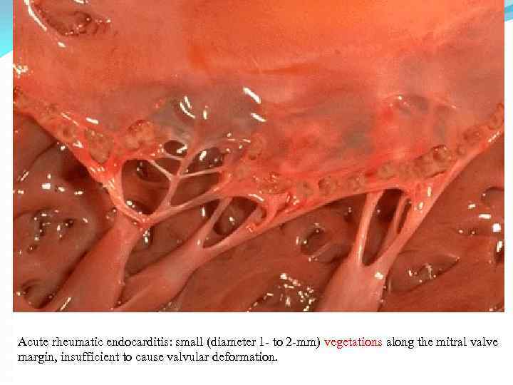 Acute rheumatic endocarditis: small (diameter 1 - to 2 -mm) vegetations along the mitral