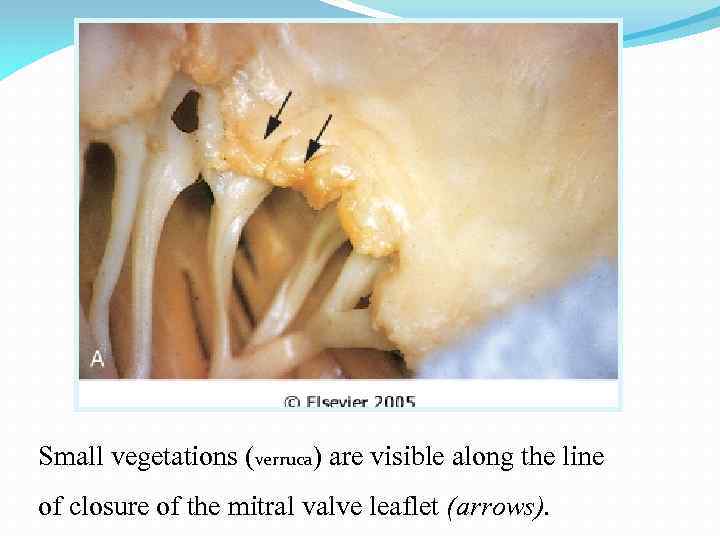 Small vegetations (verruca) are visible along the line of closure of the mitral valve