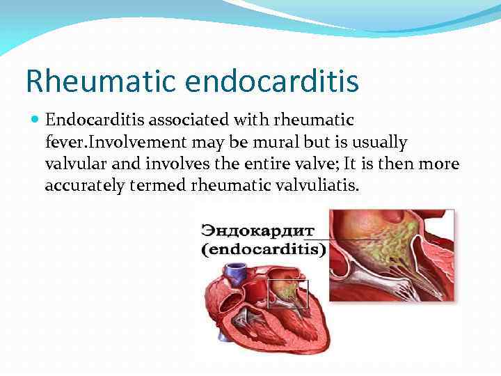 Rheumatic endocarditis Endocarditis associated with rheumatic fever. Involvement may be mural but is usually