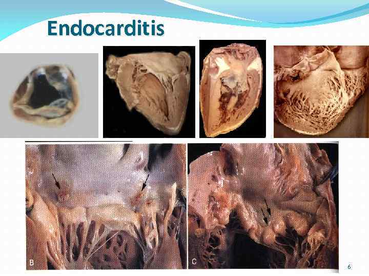 Endocarditis 6 