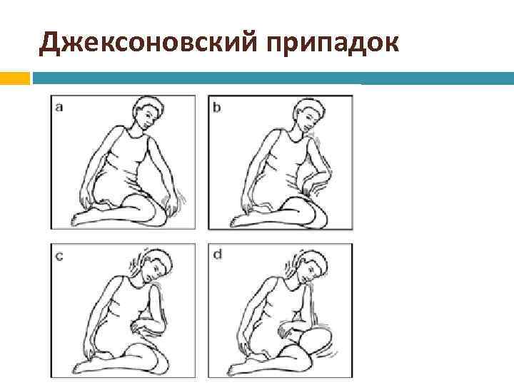 Джексоновские приступы. Судороги джексоновского типа. Джексоновские судорожные припадки. Моторная джексоновская эпилепсия. Припадки джексоновского типа.