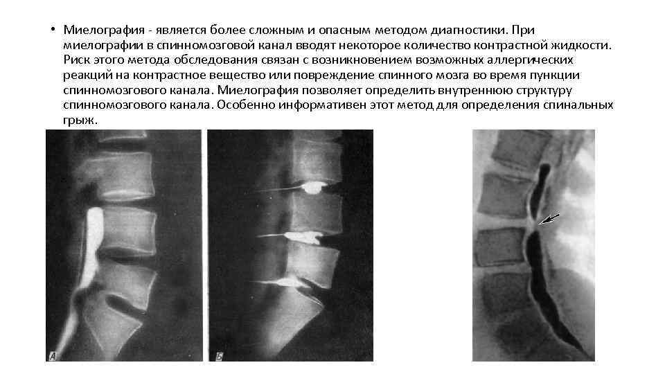  • Миелография - является более сложным и опасным методом диагностики. При миелографии в