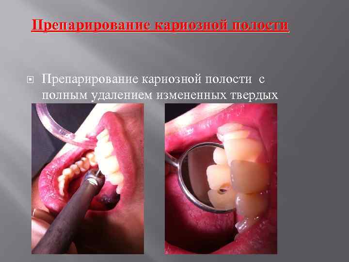 Препарирование кариозной полости с полным удалением измененных твердых тканей. 