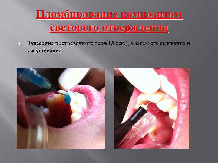 Пломбирование композитом светового отверждения Нанесение протравочного геля(15 сек. ), а затем его смывание и