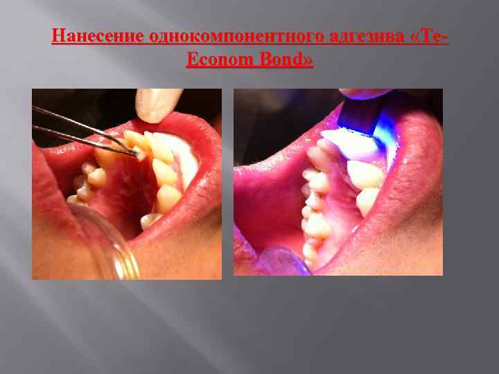 Нанесение однокомпонентного адгезива «Te. Econom Bond» 