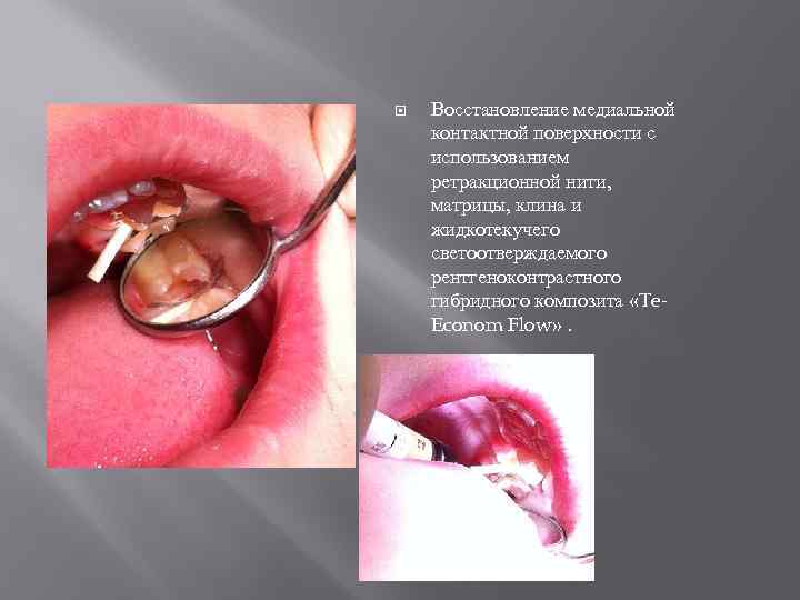  Восстановление медиальной контактной поверхности с использованием ретракционной нити, матрицы, клина и жидкотекучего светоотверждаемого