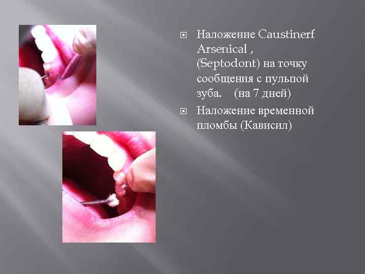  Наложение Caustinerf Arsenical , (Septodont) на точку сообщения с пульпой зуба. (на 7