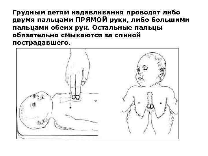 Грудным детям надавливания проводят либо двумя пальцами ПРЯМОЙ руки, либо большими пальцами обеих рук.