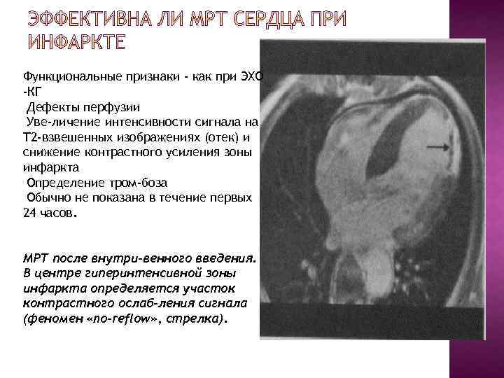 Функциональные признаки - как при ЭХО -КГ Дефекты перфузии Уве личение интенсивности сигнала на