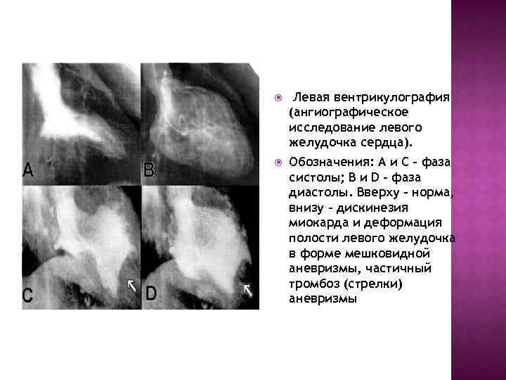  Левая вентрикулография (ангиографическое исследование левого желудочка сердца). Обозначения: А и С - фаза