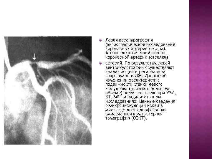  Левая коронарография (ангиографическое исследование коронарных артерий сердца). Атеросклеротический стеноз коронарной артерии (стрелка) артерий.