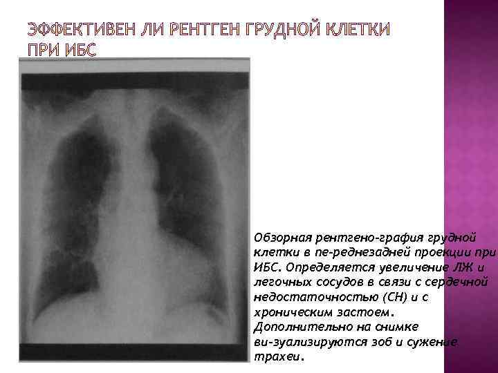 Обзорная рентгено графия грудной клетки в пе реднезадней проекции при ИБС. Определяется увеличение ЛЖ