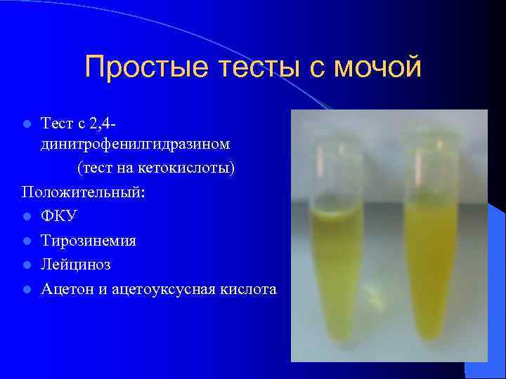 Простые тесты с мочой Тест с 2, 4 динитрофенилгидразином (тест на кетокислоты) Положительный: l