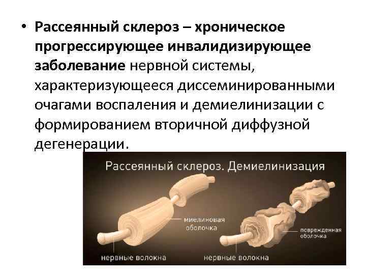  • Рассеянный склероз – хроническое прогрессирующее инвалидизирующее заболевание нервной системы, характеризующееся диссеминированными очагами