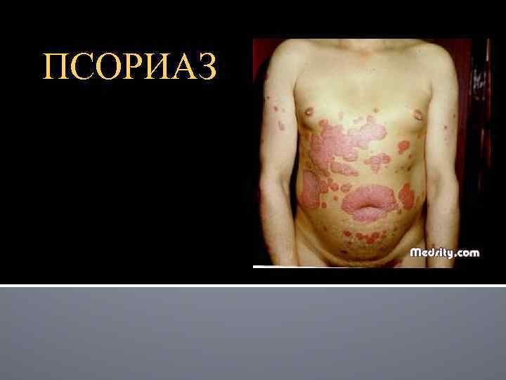 ПСОРИАЗ 