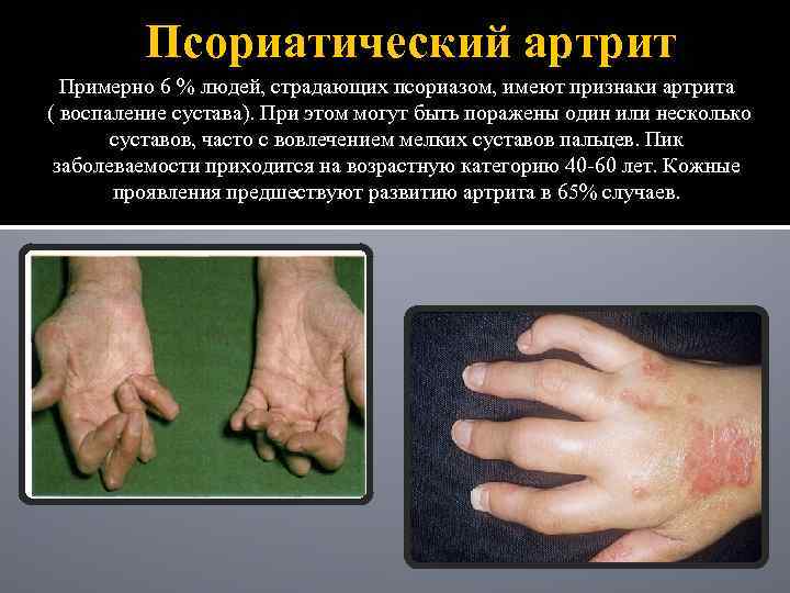 Псориатический артрит Примерно 6 % людей, страдающих псориазом, имеют признаки артрита ( воспаление сустава).
