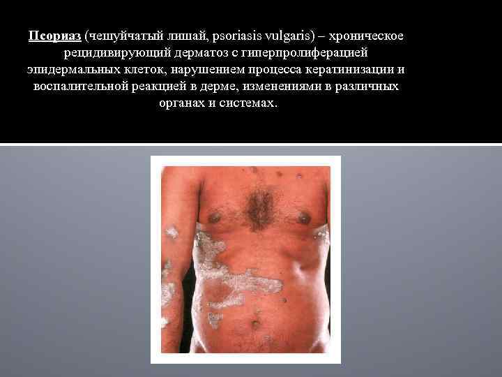 Псориаз (чешуйчатый лишай, psoriasis vulgaris) – хроническое рецидивирующий дерматоз с гиперпролиферацией эпидермальных клеток, нарушением