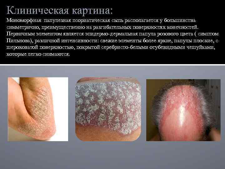 Клиническая картина: Мономорфная папулезная псориатическая сыпь располагается у большинства симметрично, преимущественно на разгибательных поверхностях
