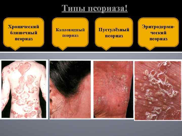 Типы псориаза! Хронический бляшечный псориаз Каплевидный псориаз Пустулёзный псориаз Эритродермический псориаз 