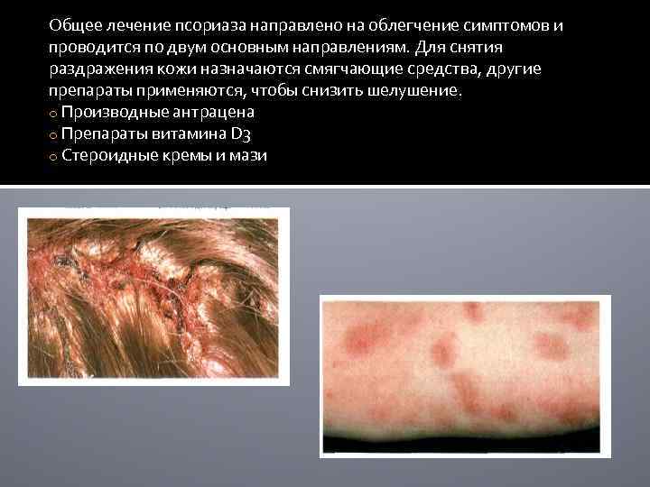 Общее лечение псориаза направлено на облегчение симптомов и проводится по двум основным направлениям. Для