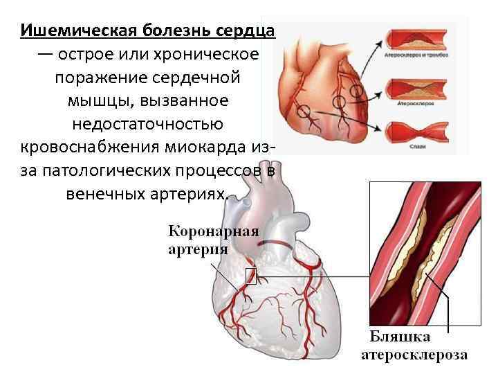 Ишемическая болезнь сердца — острое или хроническое поражение сердечной мышцы, вызванное недостаточностью кровоснабжения миокарда