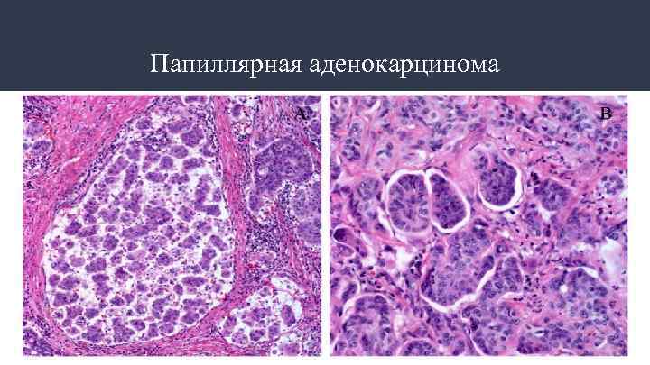 Папиллярная аденокарцинома 