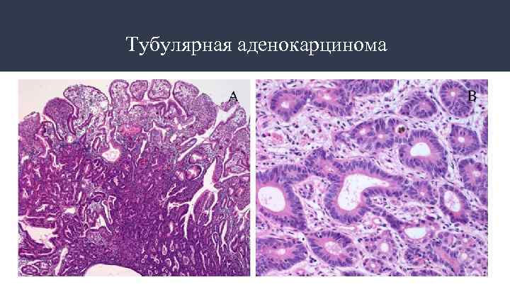 Тубулярная аденокарцинома 