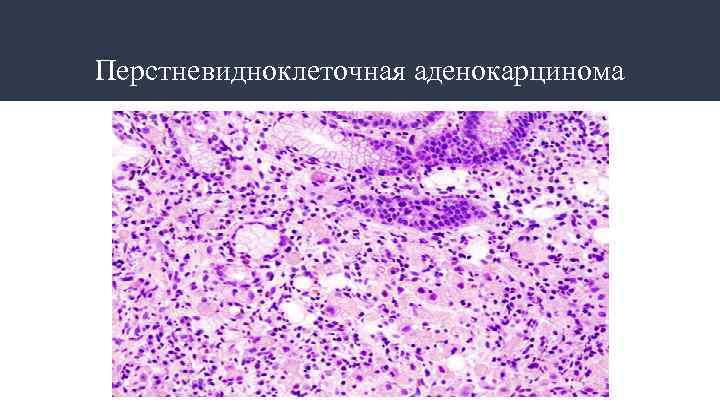 Перстневидноклеточная аденокарцинома 