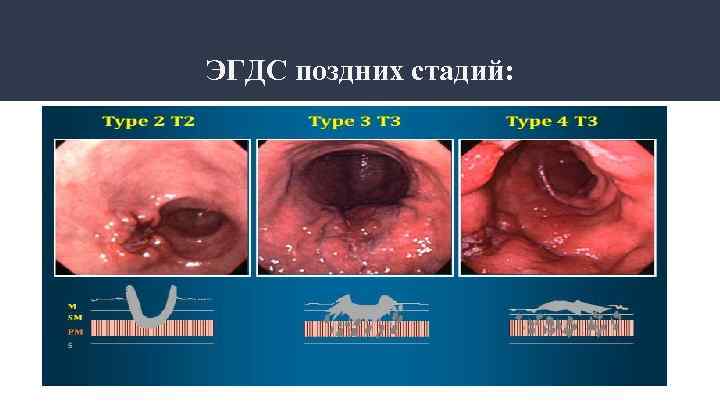 ЭГДС поздних стадий: 