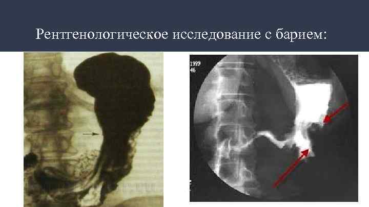 Рентгенологическое исследование с барием: 